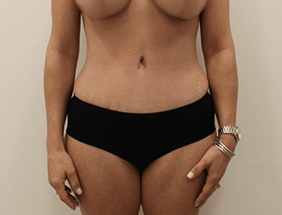 Tummy Tuck before and after - after
