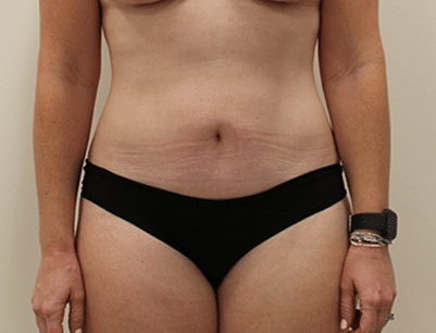 Tummy Tuck before and after - after