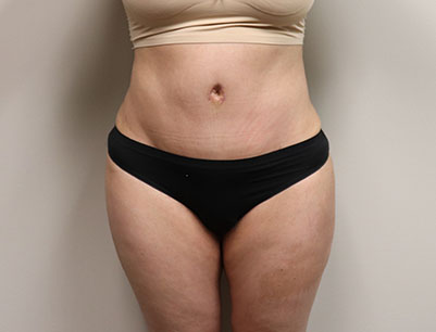 Tummy Tuck before and after - after