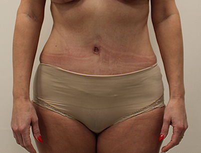 Tummy Tuck before and after - after