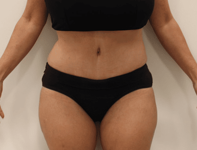 Tummy Tuck before and after - after