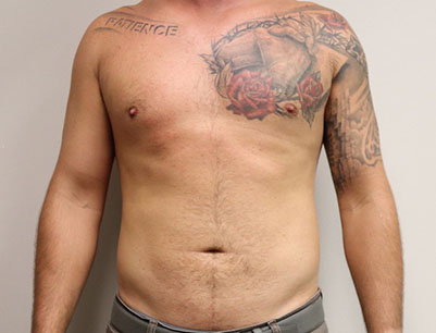 Liposuction before and after - after