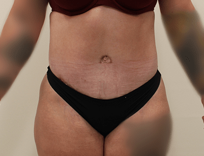 Tummy Tuck before and after - after