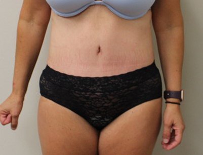 Tummy Tuck before and after - after