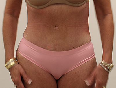 Tummy Tuck before and after - after