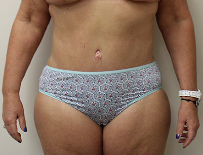 Tummy Tuck before and after - after