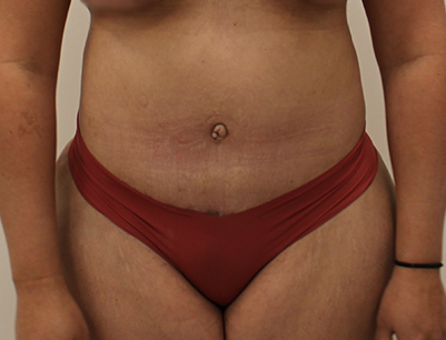 Tummy Tuck before and after - after
