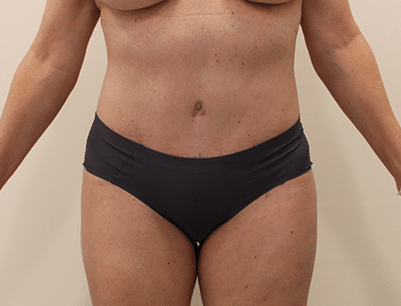Tummy Tuck before and after - after