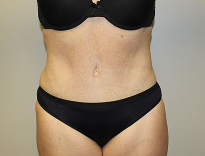 Tummy Tuck before and after - after
