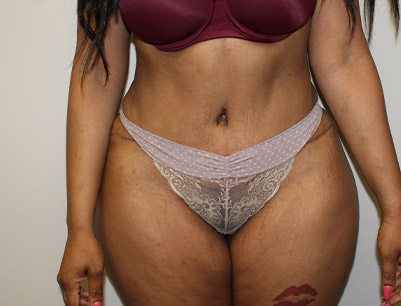 Tummy Tuck before and after - after