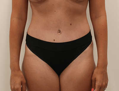 Tummy Tuck before and after - after