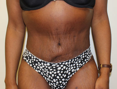 Tummy Tuck before and after - after