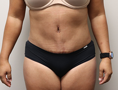 Tummy Tuck before and after - after