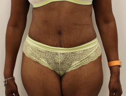 Tummy Tuck before and after - after