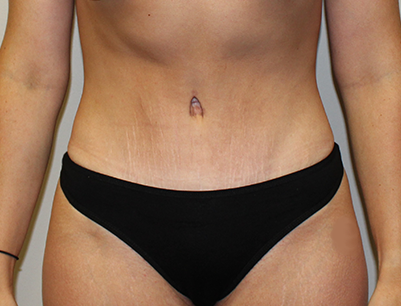 Tummy Tuck before and after - after