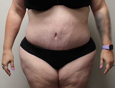 Tummy Tuck before and after - after