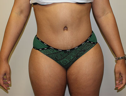 Tummy Tuck before and after - after