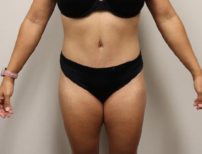 Tummy Tuck before and after - after