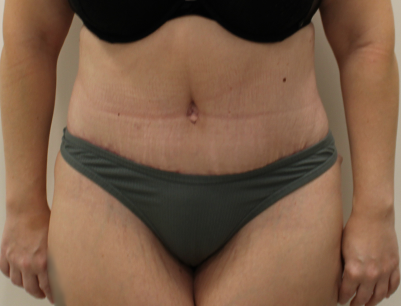 Tummy Tuck before and after - after