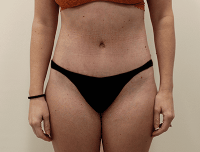 Tummy Tuck before and after - after
