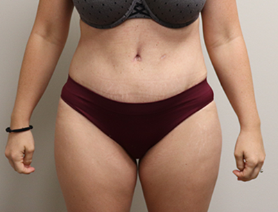 Tummy Tuck before and after - after