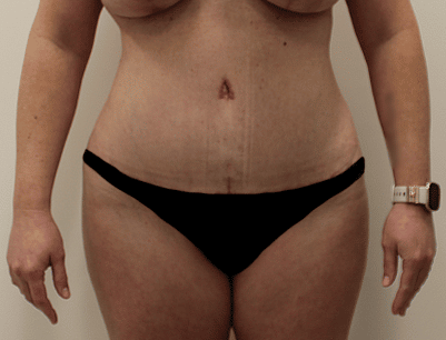 Tummy Tuck before and after - after
