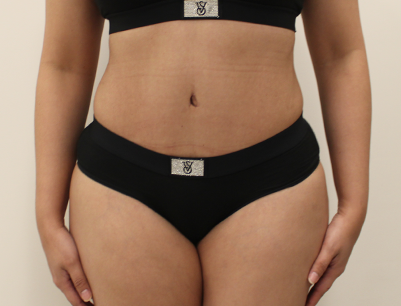 Tummy Tuck before and after - after