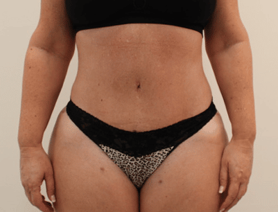 Tummy Tuck before and after - after