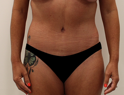 Tummy Tuck before and after - after
