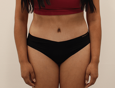 Tummy Tuck before and after - after