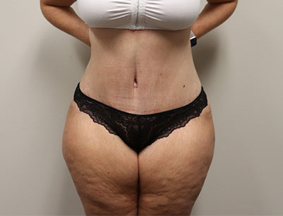 Tummy Tuck before and after - after