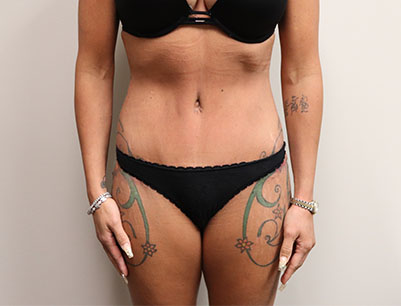 Tummy Tuck before and after - after