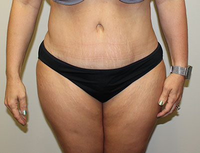 Tummy Tuck before and after - after