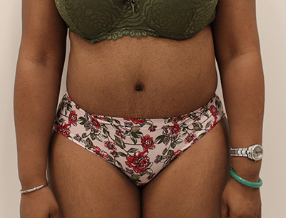 Tummy Tuck before and after - after