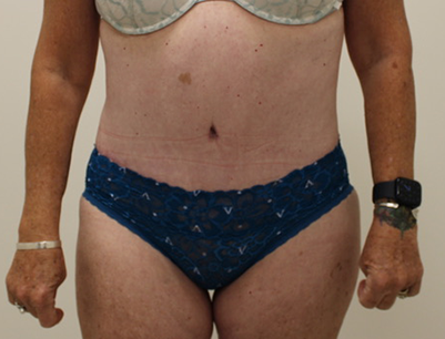 Tummy Tuck before and after - after