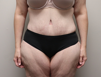 Tummy Tuck before and after - after