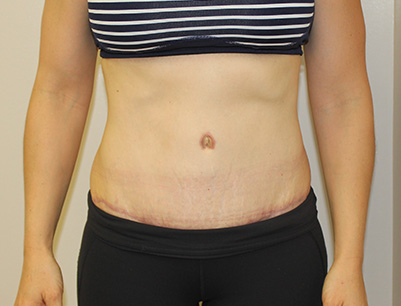 Tummy Tuck before and after - after