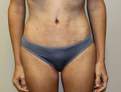 Tummy Tuck before and after - after