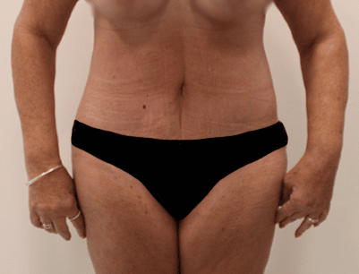 Tummy Tuck before and after - after