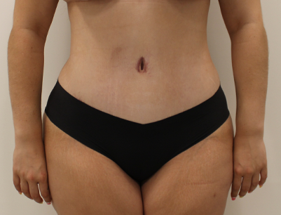 Tummy Tuck before and after - after