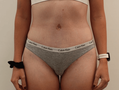 Tummy Tuck before and after - after