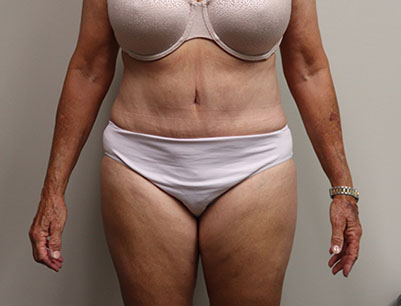 Tummy Tuck before and after - after