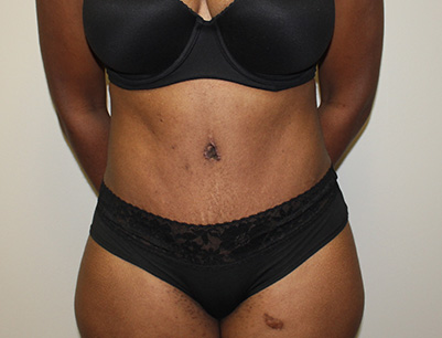 Tummy Tuck before and after - after