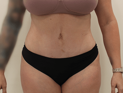 Tummy Tuck before and after - after