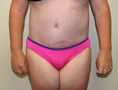 Tummy Tuck before and after - after