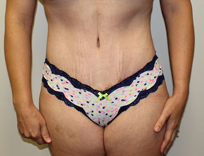 Tummy Tuck before and after - after
