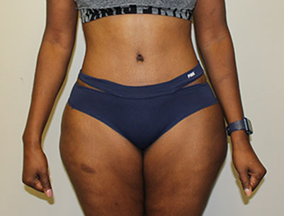 Tummy Tuck before and after - after