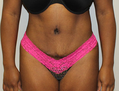 Tummy Tuck before and after - after