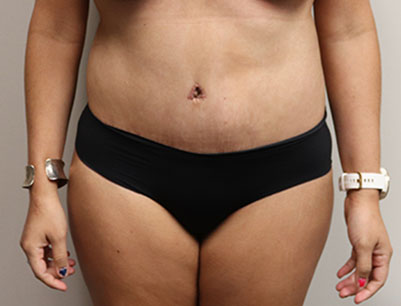 Tummy Tuck before and after - after