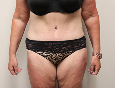 Tummy Tuck before and after - after